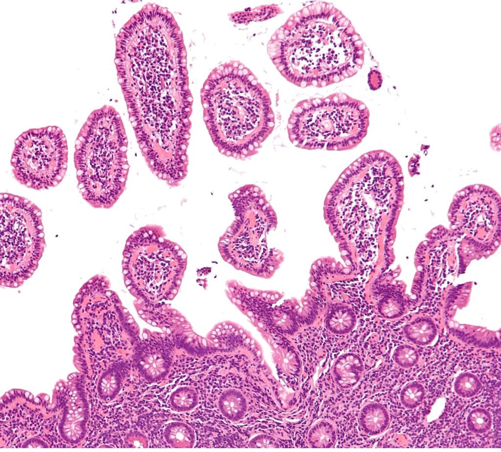 1440px-Mantle_cell_lymphoma_-_intermed_mag