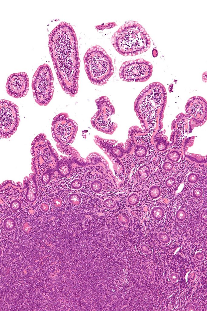 1440px-Mantle_cell_lymphoma_-_intermed_mag