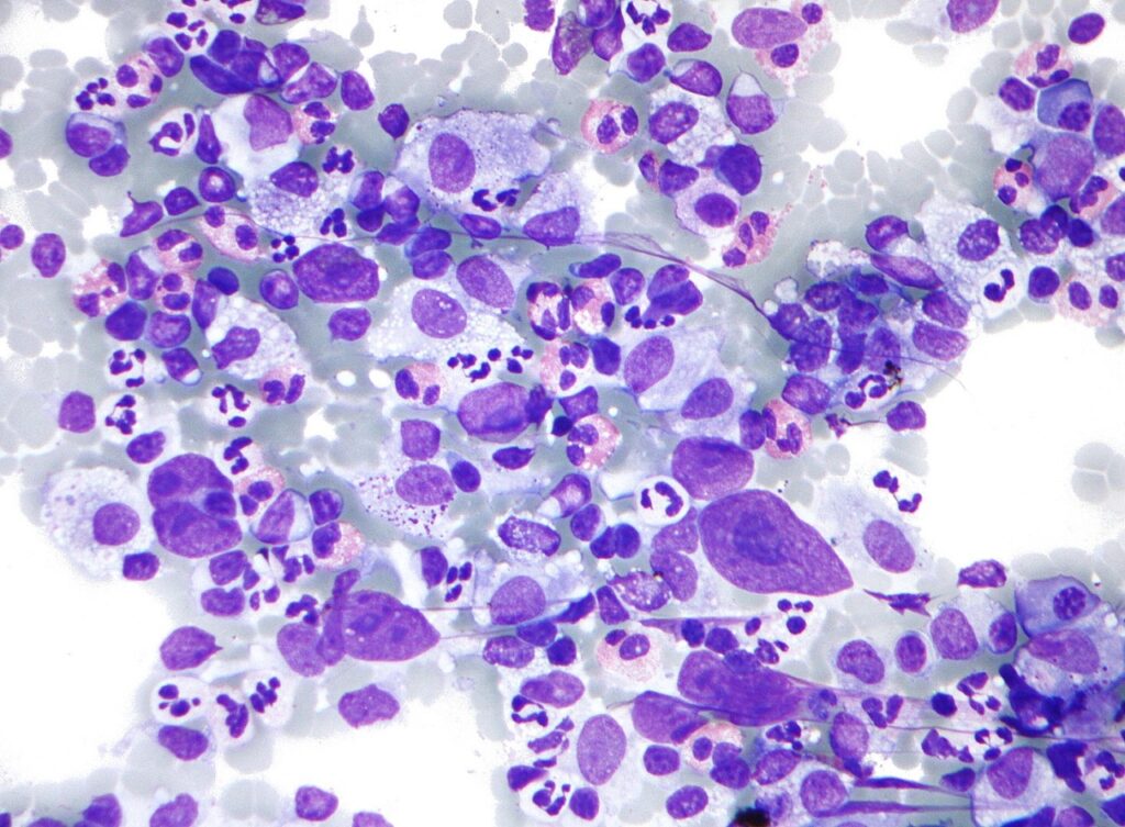1468px-Hodgkin_lymphoma_cytology_large