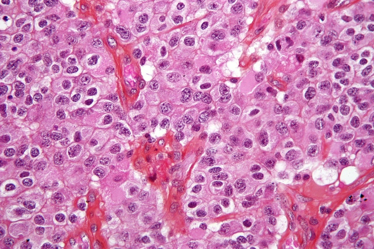 VBI Vaccines gets orphan drug designation for glioblastoma therapy - Vimarsana News