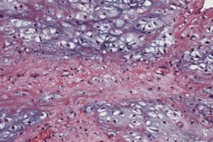 Inhibrx gets EC orphan drug designation for chondrosarcoma therapy
