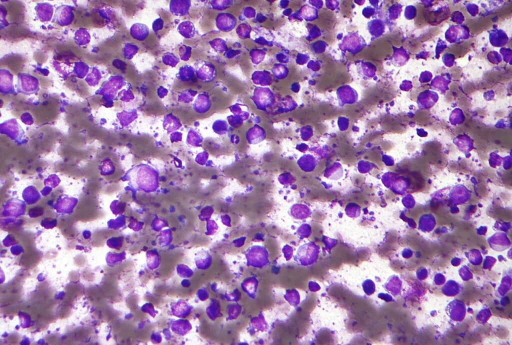 1601px-Diffuse_large_B_cell_lymphoma_-_cytology_low_mag