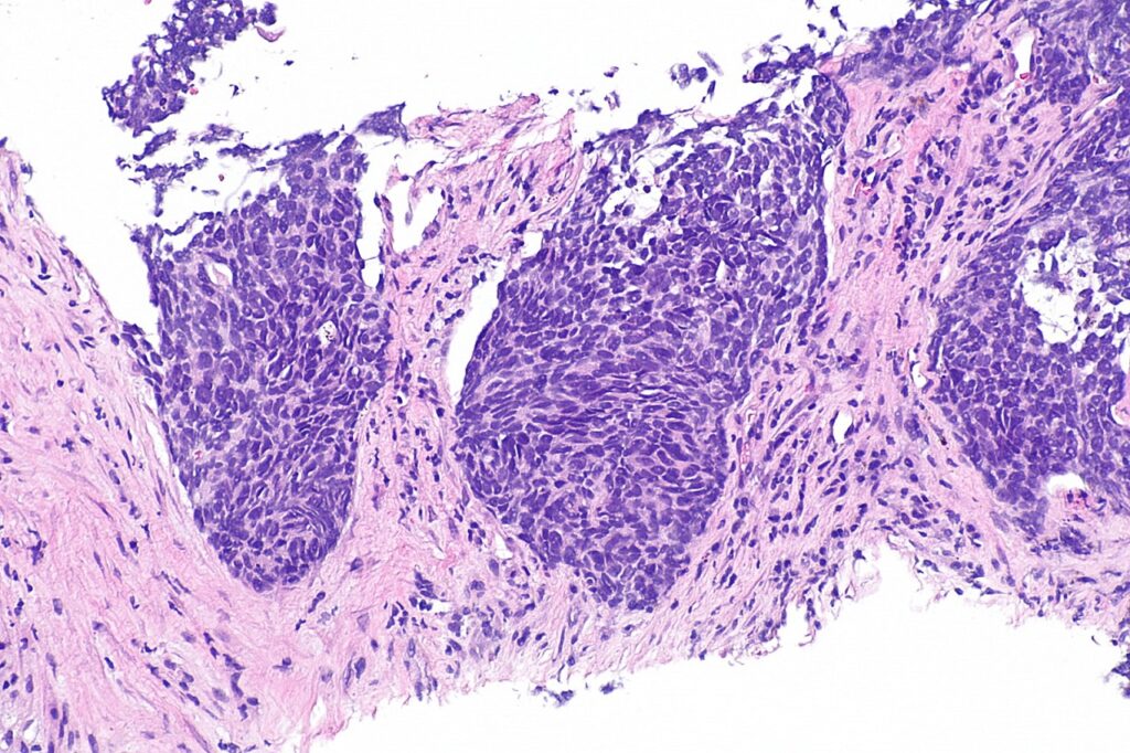 1620px-Non-small_cell_lung_carcinoma_--_intermed_mag