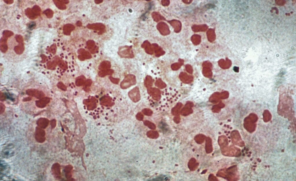 1764px-Gram-stain_of_gonorrhoea