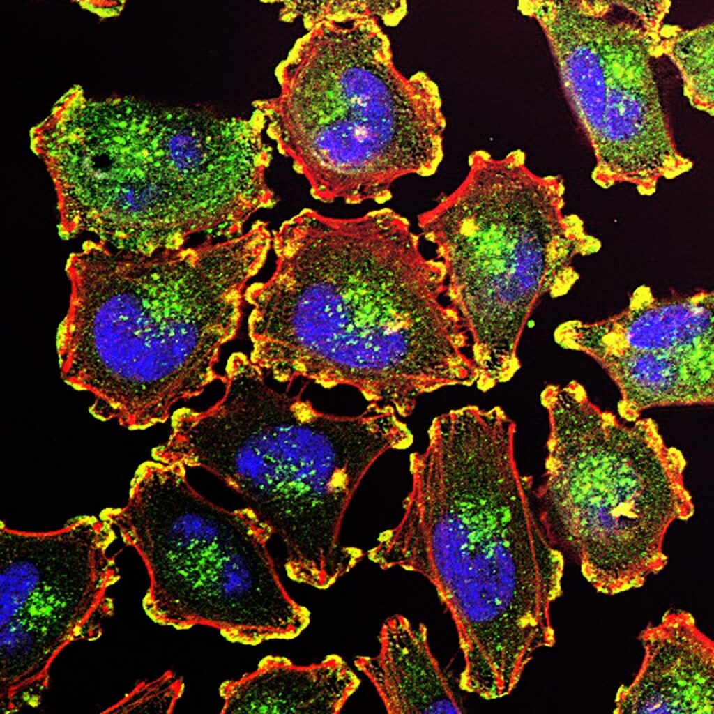 The ability of cancer cells to move and spread depends on actin-rich core structures such as the podosomes (yellow) shown here in melanoma cells. Credit: Julio C. Valencia / commons.wikimedia.org.