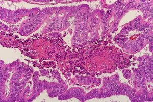 FDA accepts for priority review Seagen’s sNDA for colorectal cancer medicine