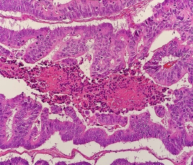 Micrograph_of_colorectal_carcinoma_with_dirty_necrosis