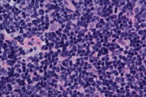 InnoCare receives approval in Singapore for mantle cell lymphoma therapy