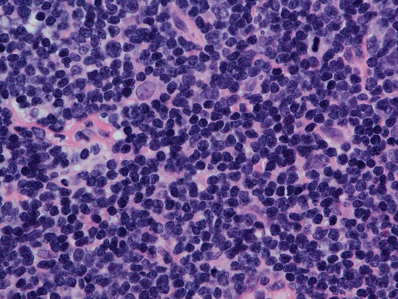 Mantle_Cell_Lymphoma