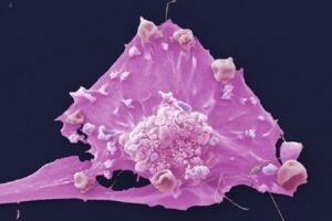 NICE recommends MSD’s pembrolizumab to treat breast cancer