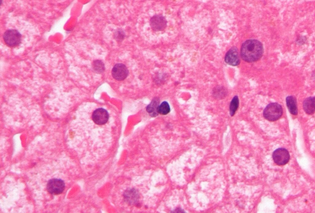 Micrograph of ground glass hepatocytes, as seen in a chronic hepatitis B infection. Credit: Nephron / commons.wikimedia.org. 