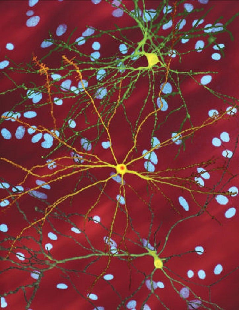 Alchemab, MDC receive grant to develop Huntington's disease therapy - Vimarsana News