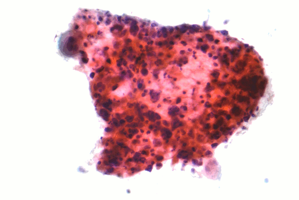 Squamous_carcinoma_lung_cytology-05Jan2023