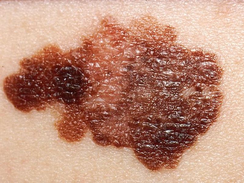 The slide shows melanoma on a patient's skin. Credit: Doc James / commons.wikimedia.org.