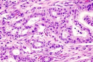CanariaBio receives orphan drug designation for pancreatic cancer therapy