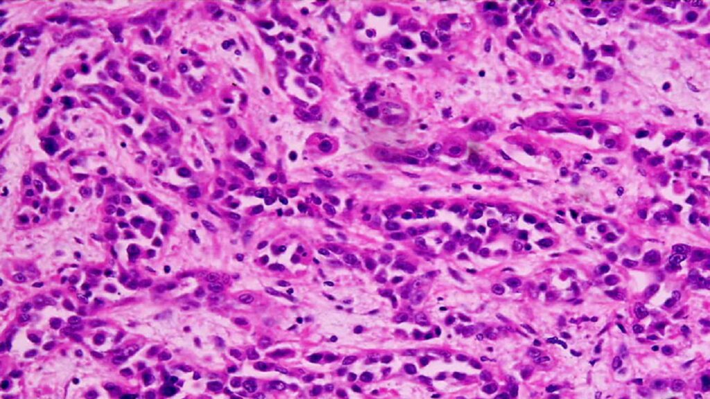 1125px-Adenocarcinoma_low_differentiated_(stomach)_H&E_magn_400x