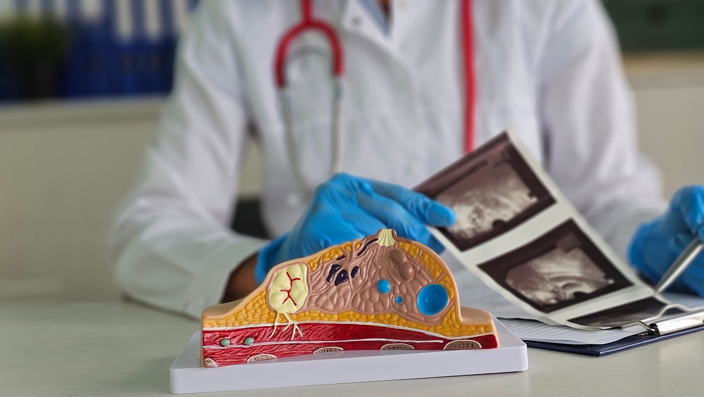 MHRA approves Roche Products’ inavolisib for breast cancer