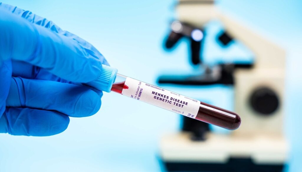 Zycubo is administered subcutaneously to restore copper balance and maintain appropriate copper levels in affected patients. Credit: luchschenF / Shutterstock.com.