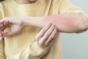 Sanofi receives CHMP recommendation for Dupixent approval in Europe