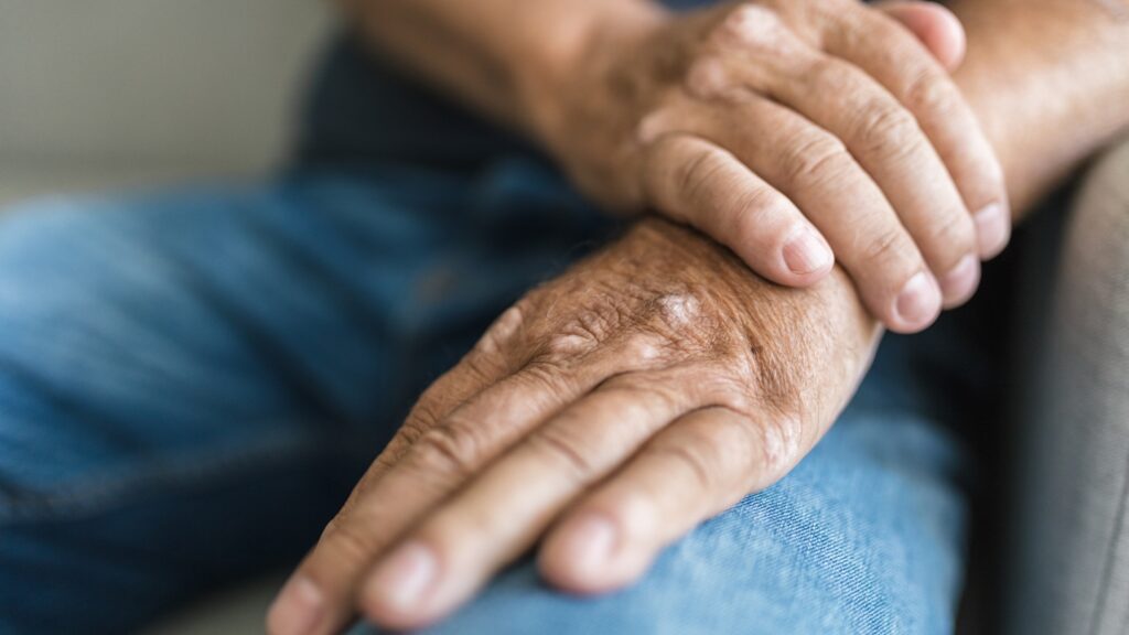 Elderly,Man,Suffering,From,Psoriasis,,Closeup,On,Hands