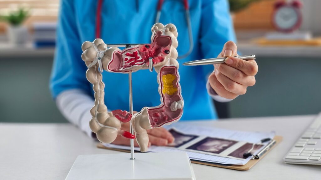 Colon,Diseases,And,Colorectal,Cancer,And,Ulcerative,Colitis.,Irritable,Bowel