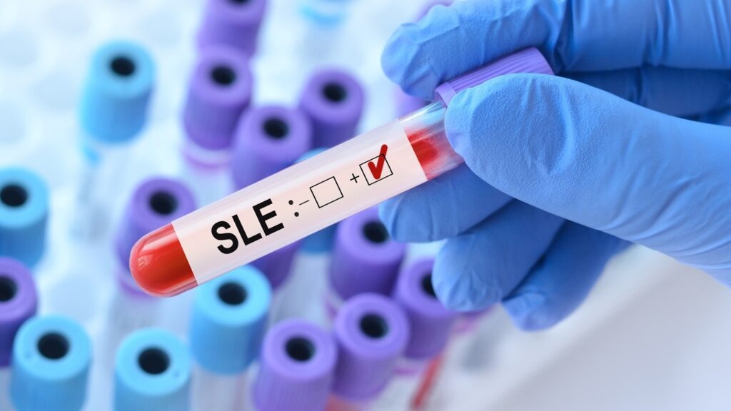 SLE is an autoimmune condition causing symptoms such as joint swelling, rashes, and organ damage. Credit: StanislavSukhin / Shutterstock.com.