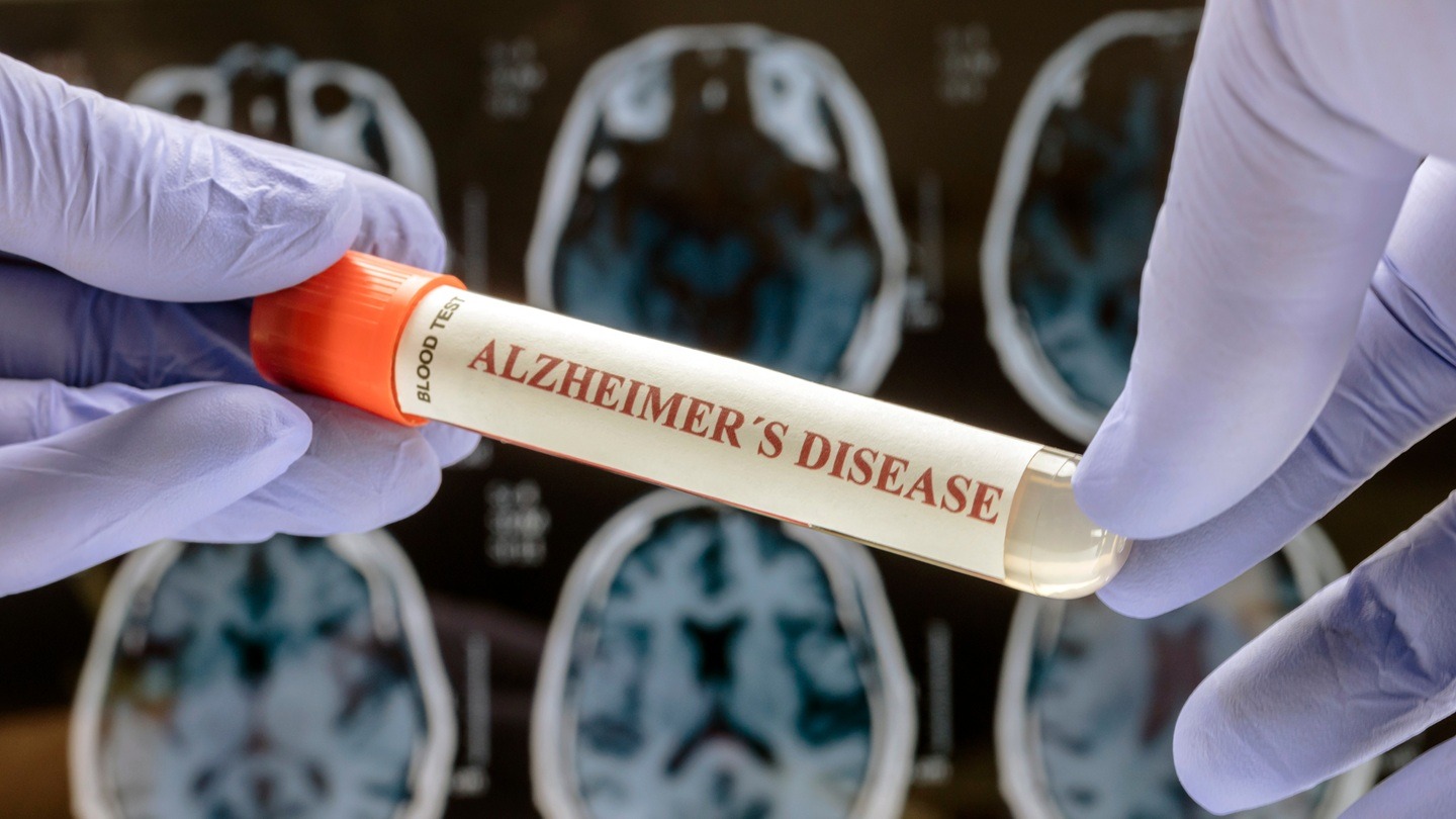 Axsome receives FDA approval for Auvelity to treat Alzheimer’s agitation