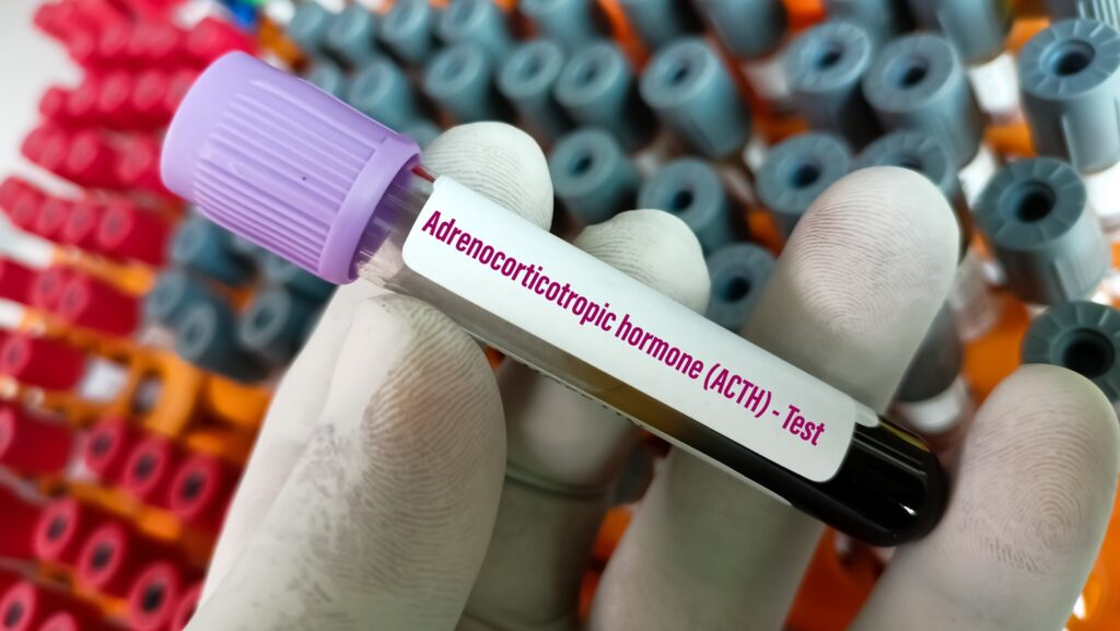 Cushing’s syndrome of endogenous origin is a rare endocrine disease caused in most instances by excessive ACTH production. Credit: Arif biswas / Shutterstock.com.