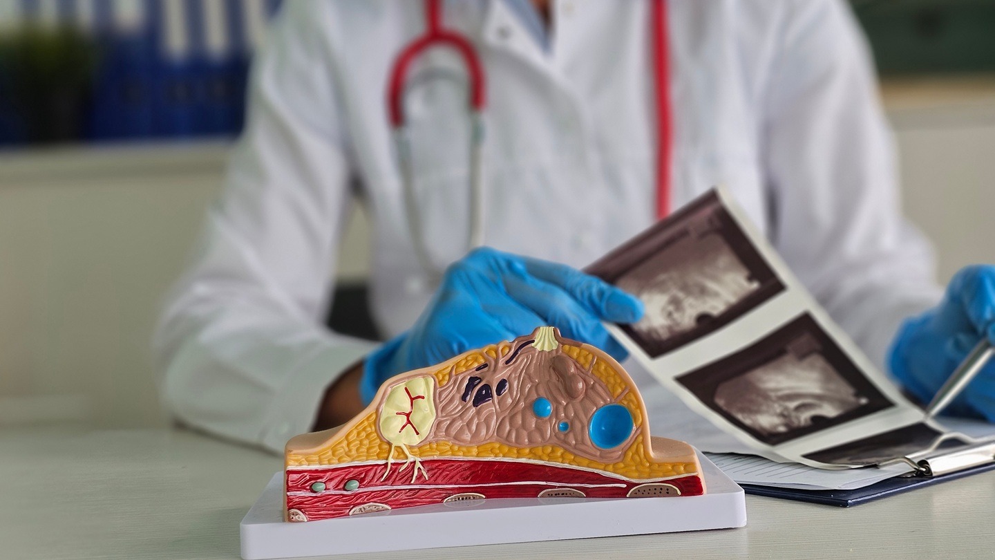 FDA approves AstraZeneca’s Etcamah combo for advanced breast cancer