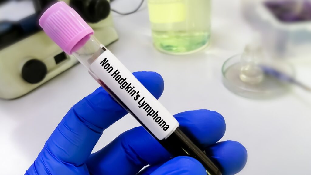 Scientist,Hold,Blood,Sample,For,Non-hodgkin,Lymphoma,(nhl),Test.,Non