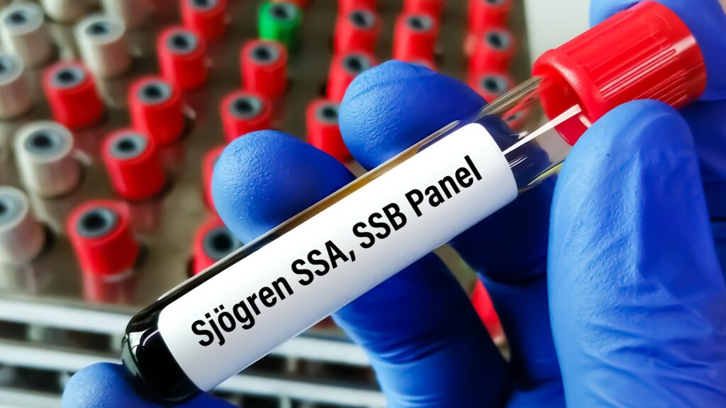 Sjögren’s disease damages moisture-producing glands, causing dry mouth. Credit: Saiful52 / Shutterstock.com.